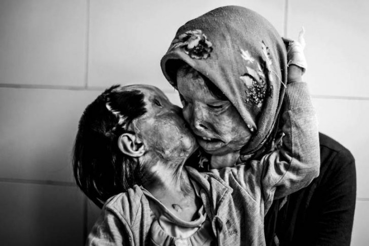 Mama i jej 3-letnia córka, które zostały oblane kwasem przez męża