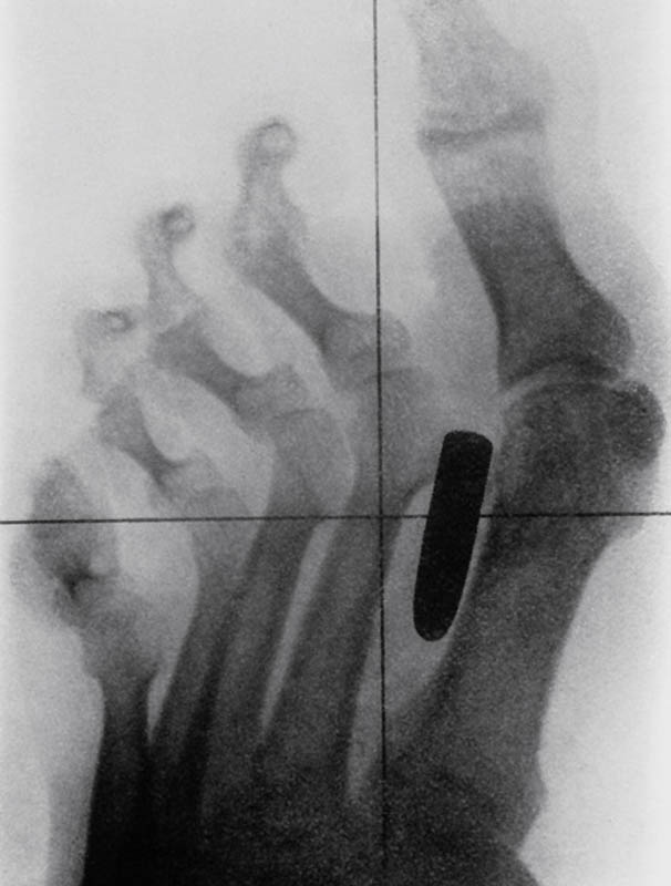 Historyczne zdjęcie rentgenowskie żołnierza wojny burskiej