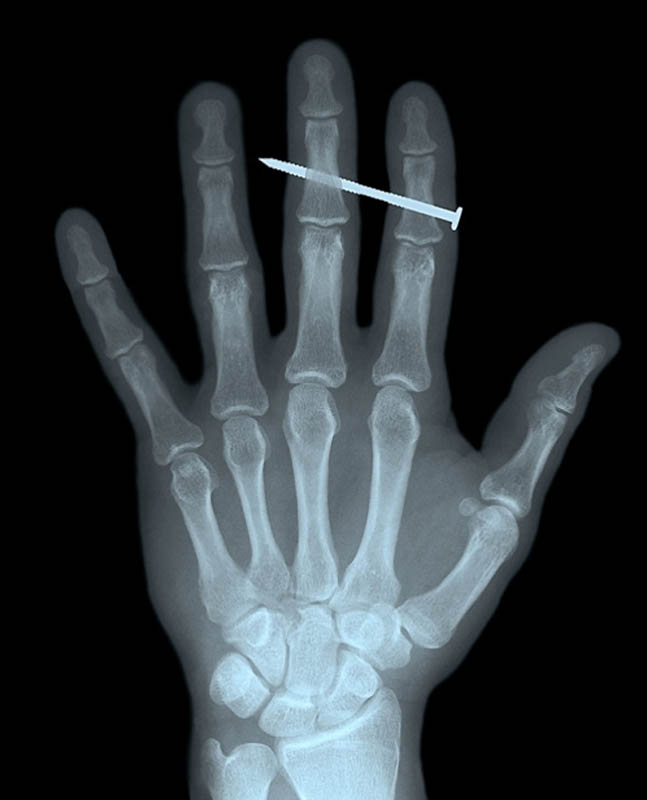 Palce wskazujący i środkowy dorosłego mężczyzny przebite gwoździem.