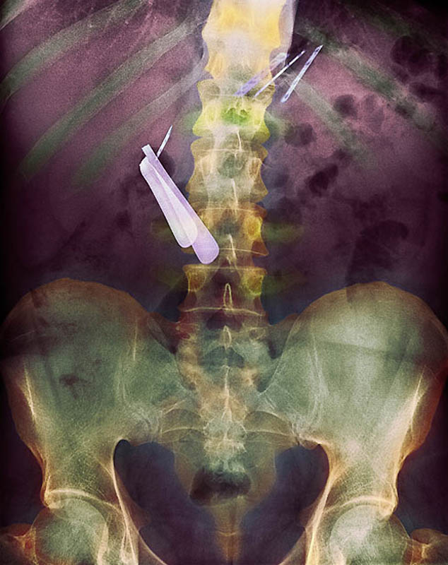 Kolorowe rentgenowskie zdjęcie żołądka pacjenta, który połknął brzytwę (środek) i ostrze (prawy górny róg).
