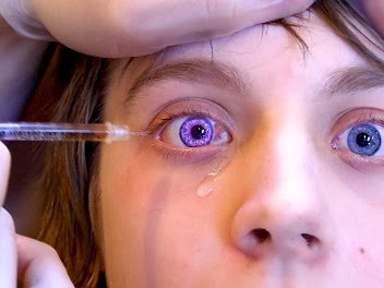 Osoba z bielactwem oczu podczas zabiegu chirurgicznego. Fioletowy kolor tęczówki jest wynikiem oświetlania. Źródło: flickr