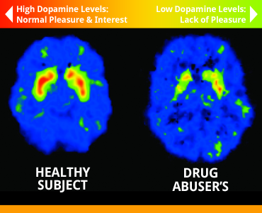 Mózg osoby zdrowej (po lewej) i uzależnionej od narkotyków (po prawej)