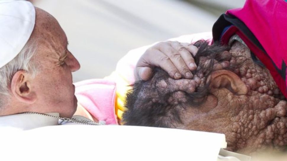 Papież Franciszek obejmuje Vinicio Riva, mężczyznę chorego na genetyczną chorobę. (2013)