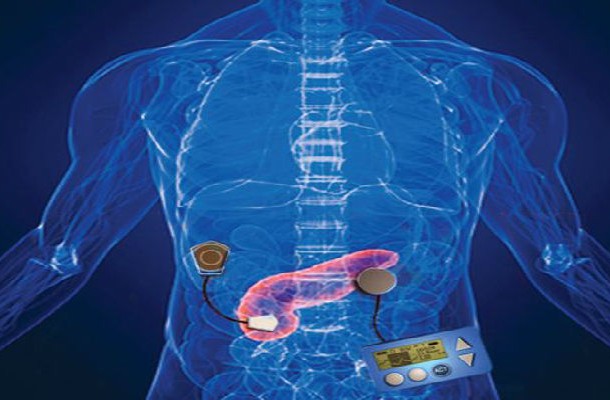 The-Artificial-Pancreas-610x400