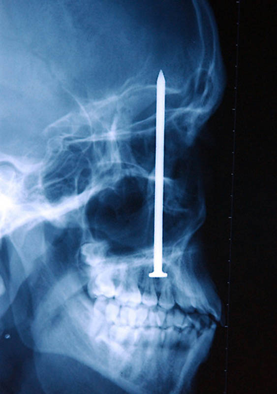 Gwóźdź w ludzkiej czaszce - pacjent przypadkowo strzelił do siebie z pistoletu na gwoździe. Co dziwniejsze nie zorientował się, że ma w sobie 10-cm długości gwóźdź - odkryto go po 6 dniach!